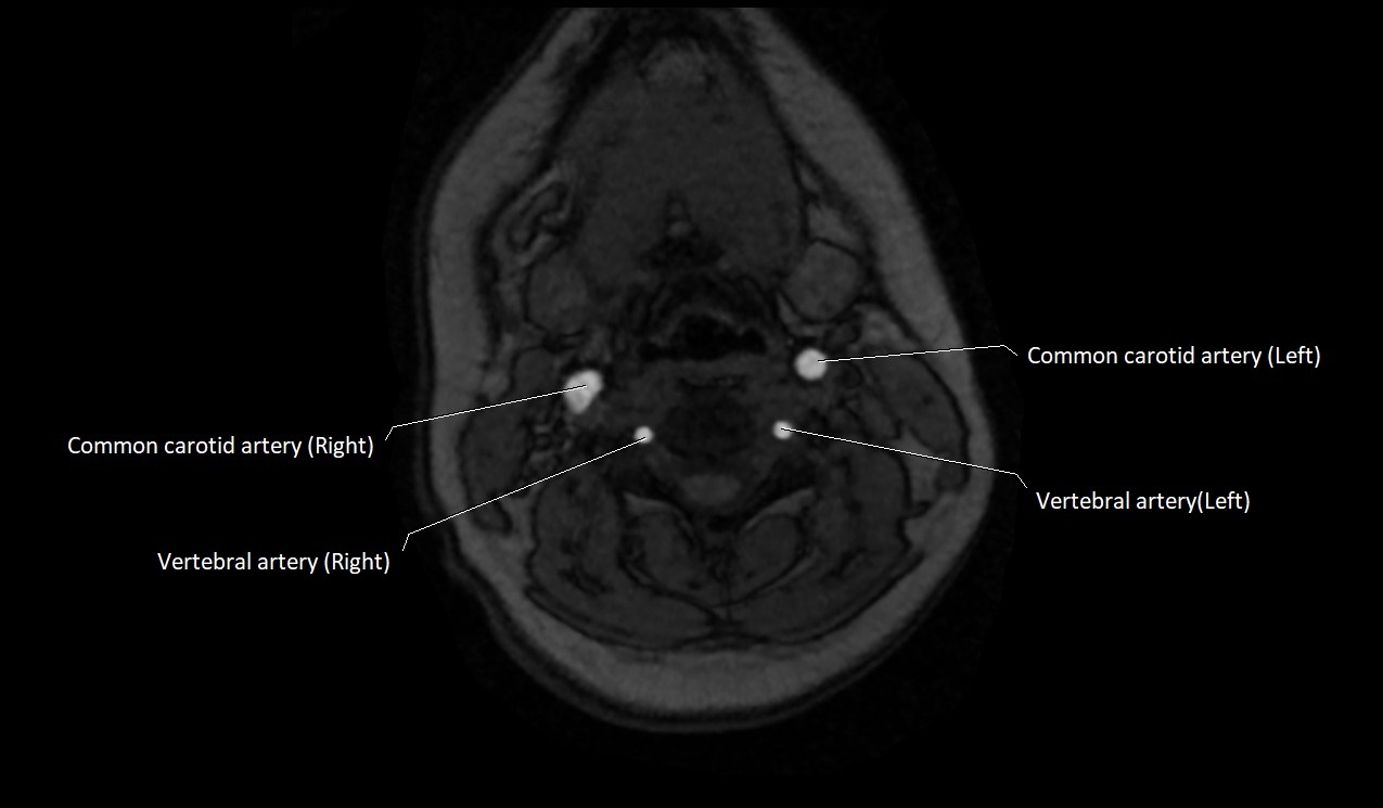 Carotid artery anatomy axial 3T image 30.jpg